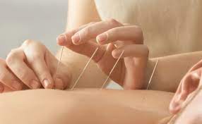 acupunctura bucuresti