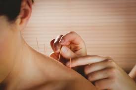 acupunctura